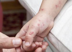Λάρισα: Θερίζει το κοξάκι στα παιδιά - 41 κρούσματα