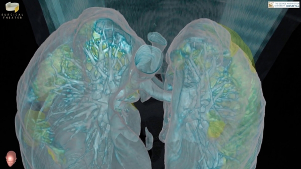 3D βίντεο δείχνει την ζημιά που προκαλεί ο κορωνοϊός στους πνεύμονες ασθενή